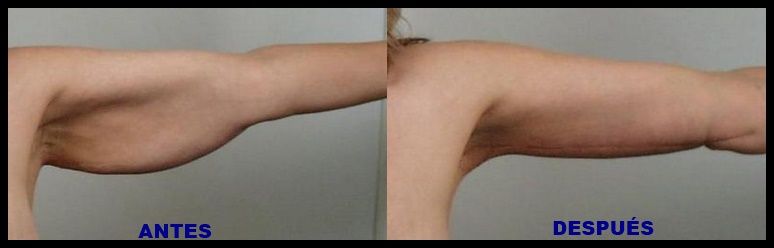 braquioplastia EDIT
