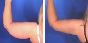 lipo brazo
