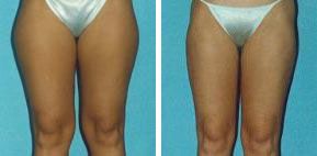 liposuction muslos