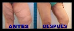 dermolipectomia 2edi