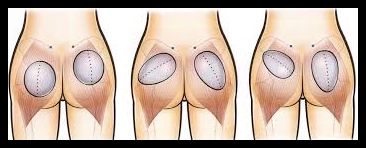 AUMENTO GLUTEO CON PROTESIS