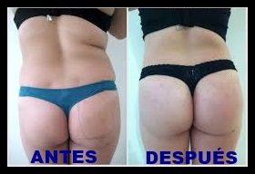 AUMENTO GLUTEOS EDI