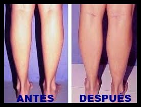 aumento pantorillas EDIT
