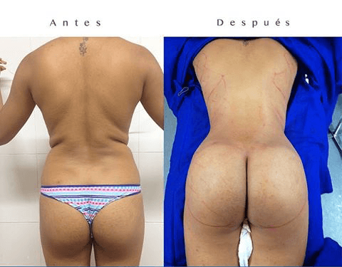 lipotrasnferencia