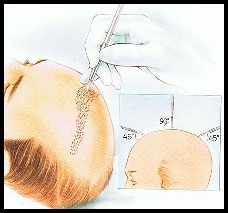 transplante de pelo EDI