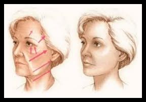 liftig cervico facial EDI