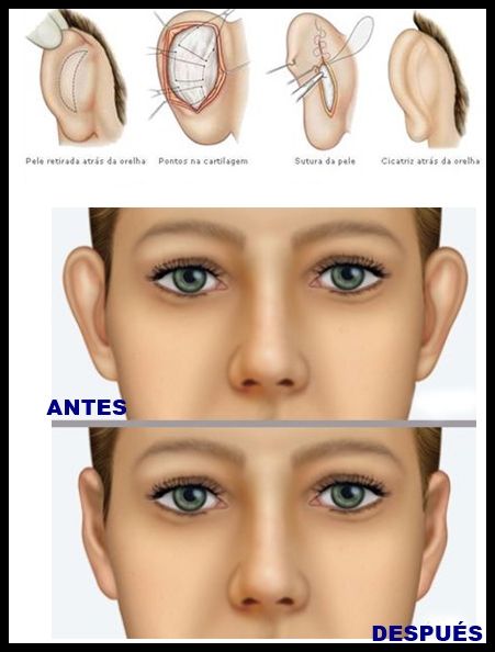 ilustracao otoplastia EDIT