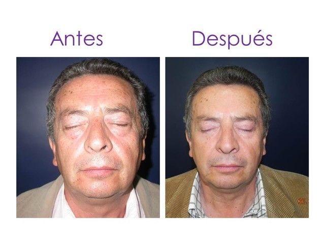 cirugia parpados homb