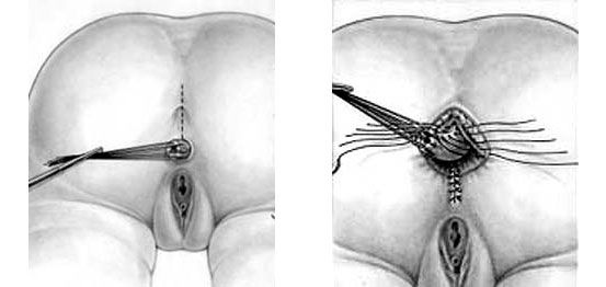 fistula 2