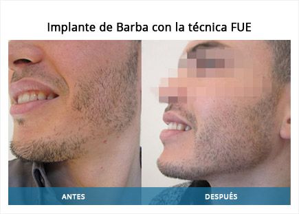 implanta barba