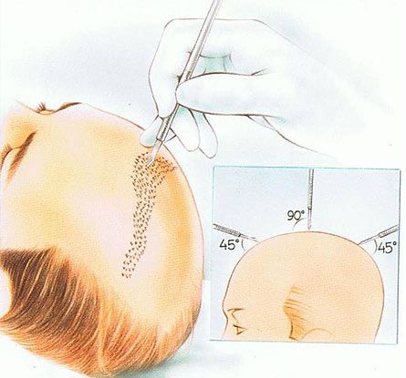 transplante de pelo
