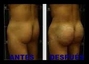 AUMENTO GLUTEO HOMBRE