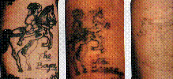 elimin tatuaje