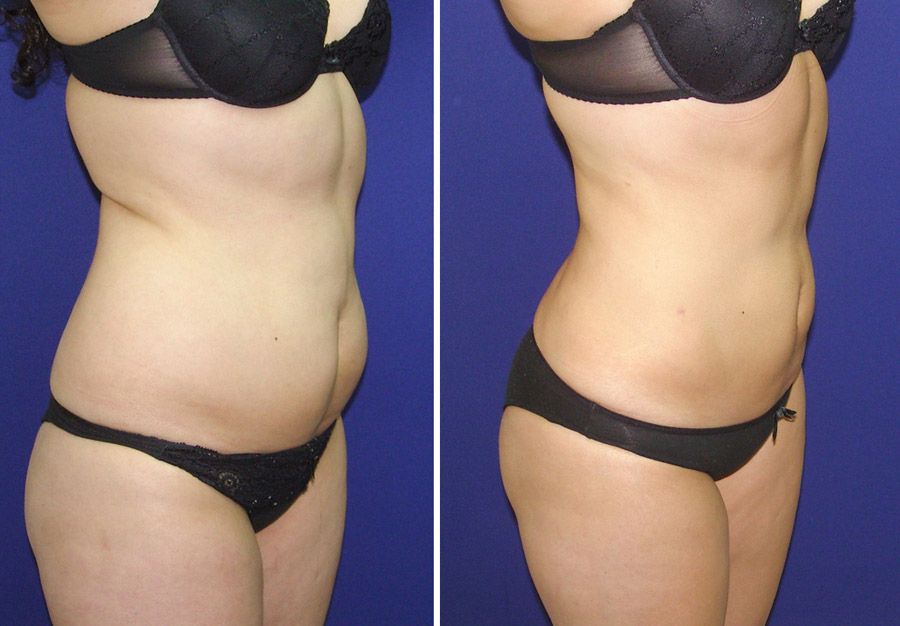 mesoterapia resultados