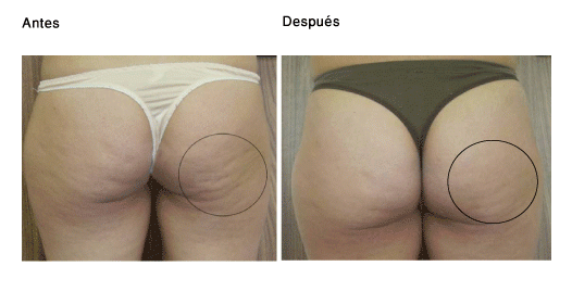 mesoterapia