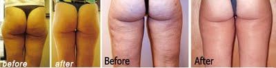 mesoterapia