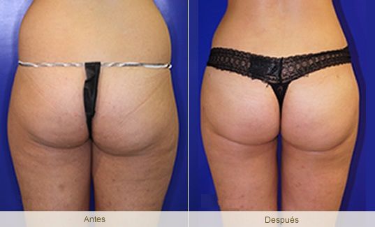vacumterapia2