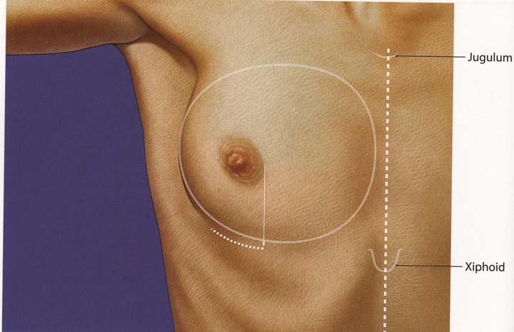 Mamoplastia Aumento figura 1