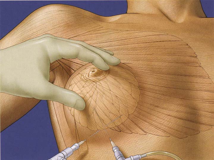 Mamoplastia Aumento figura 2
