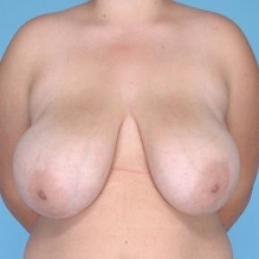 breast reduction 15lk