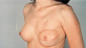 mastectomia