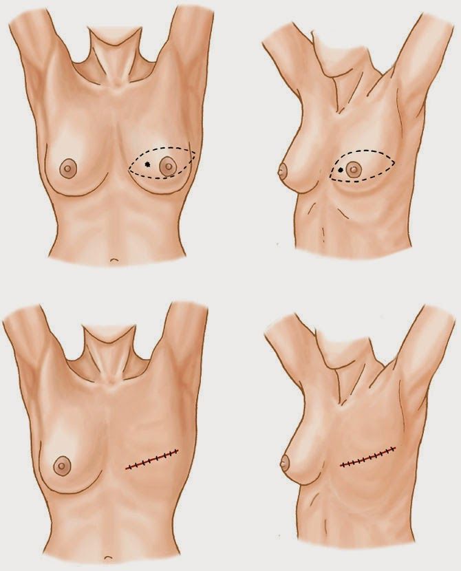 mastectomia profilaticas