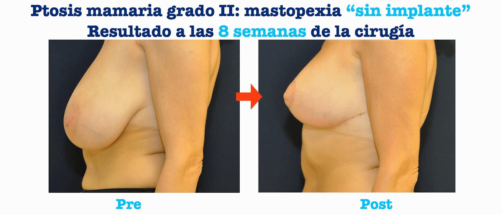 mastopexia sin implantes