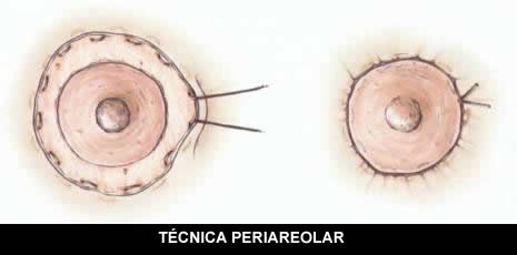 reduccion areola