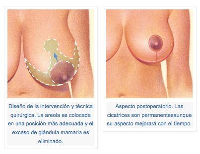 reduccion2