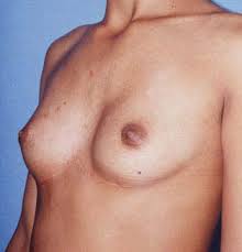 sindrome poland