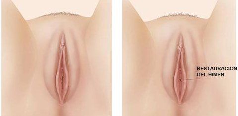 2fd2b3e131 Himenoplastia