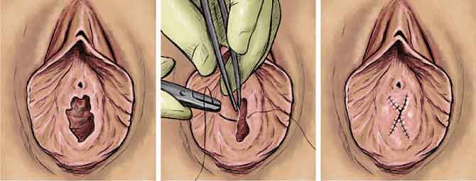 HIMENOPLASTIA
