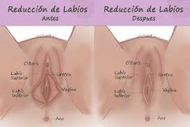reduccion labios