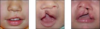 fisura labial