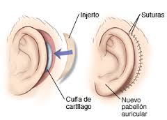 cirugia pab auricular