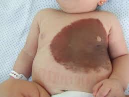 nevus gigante
